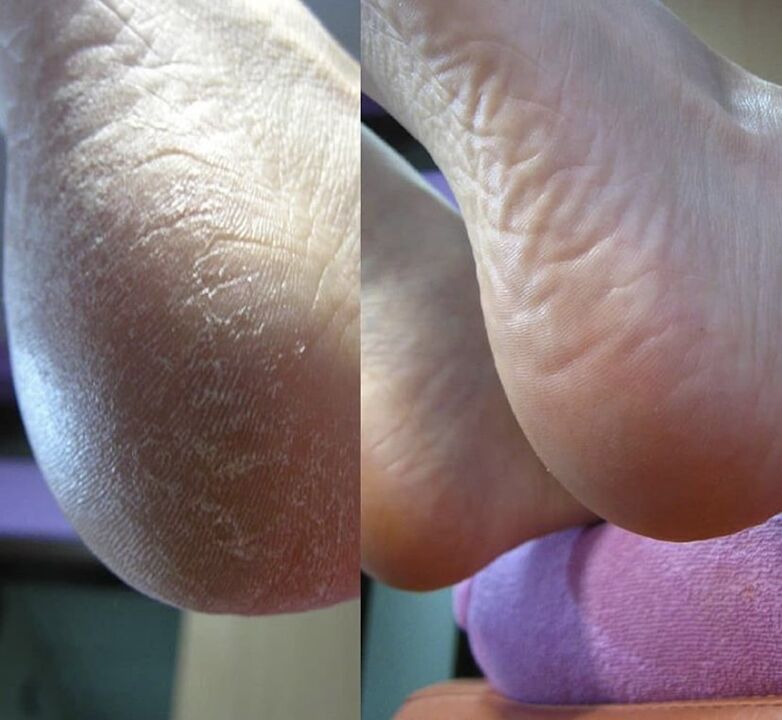 Photo of the heel of the foot before and after using the cream Zenidol