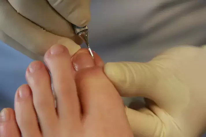 Yeast infection during a pedicure. 