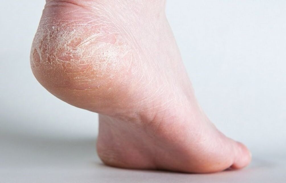 leg skin fungus how to treat