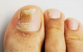 Nails affected by fungus. 