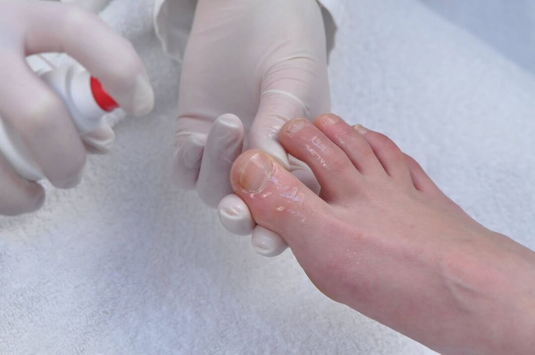 How to treat nail fungus