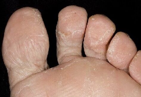 The initial stage of the fungus, between the fingers