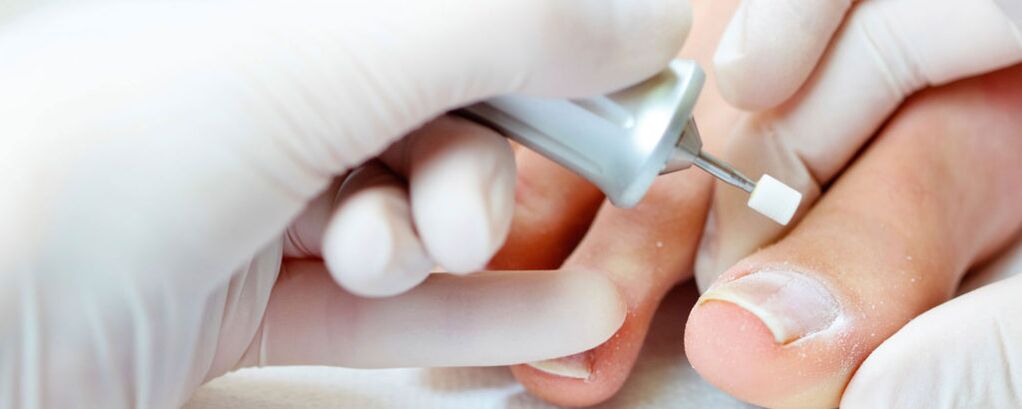 Cut the upper nail layer