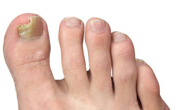 Fungus on the thumb