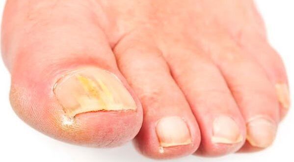 Nail fungus