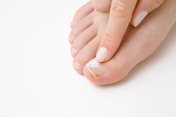 Finge treatment with fungus ointment