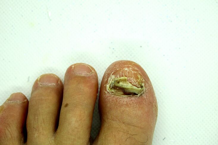 Finger fungus - heavy stage