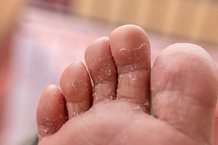 Finger skin fungus - initial stage