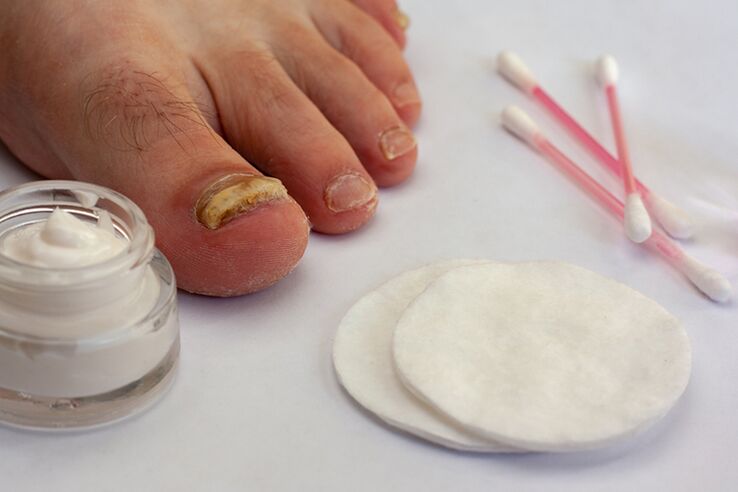 Fungus fungus treatment with fungus cream