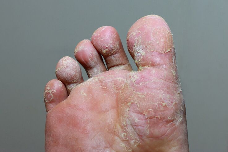Severe stage of skin mycosis with fingers