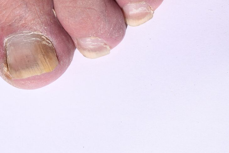 The initial stage of nail mycosis on the legs