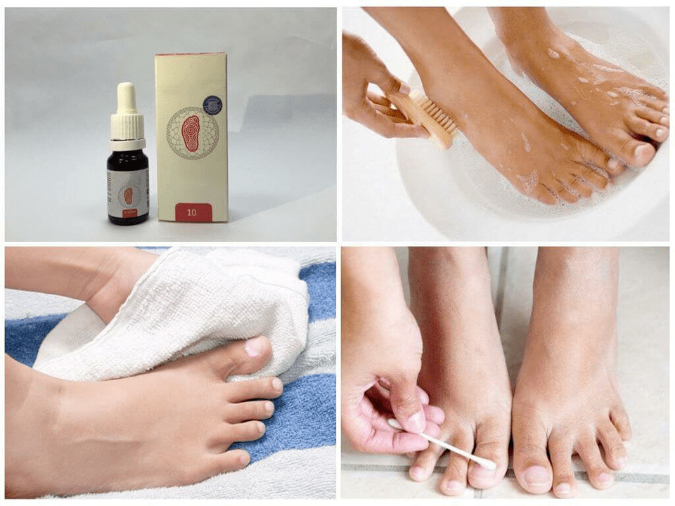 Various remedies for foot fungus.