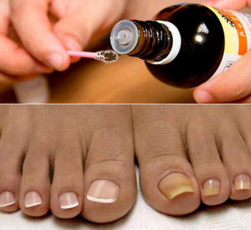 iodine against fungus