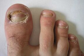 Damage to the nail plates of the toes due to a fungal infection.