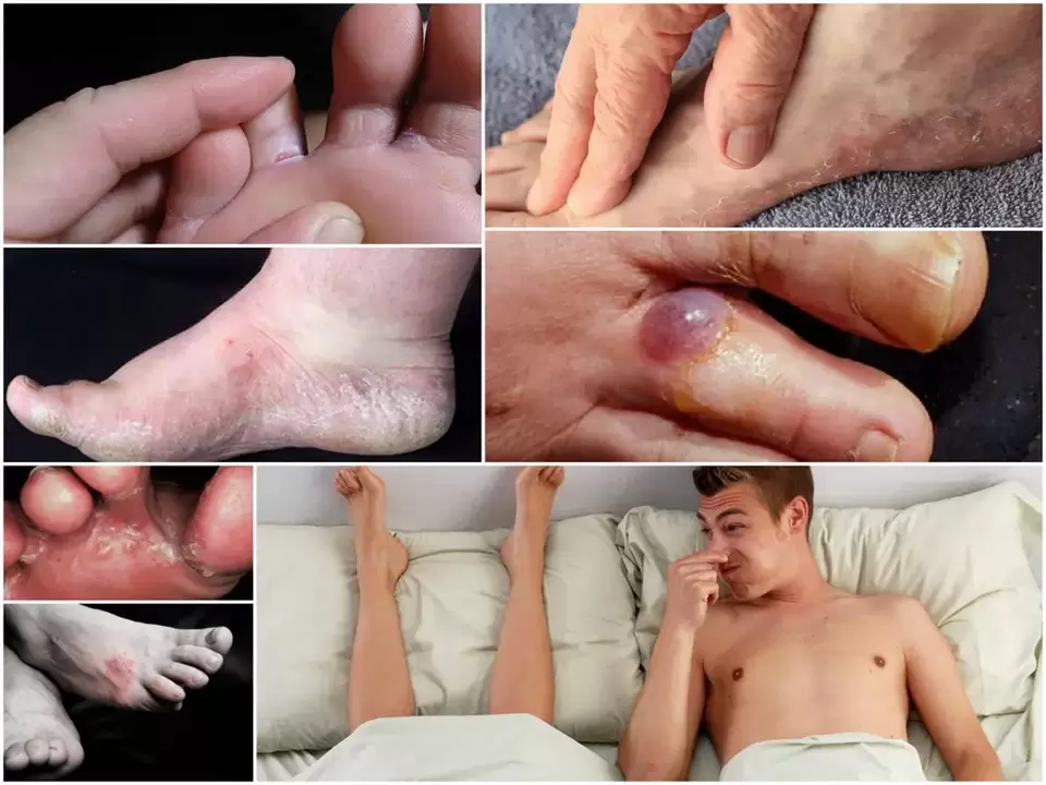 Main signs of foot fungus.