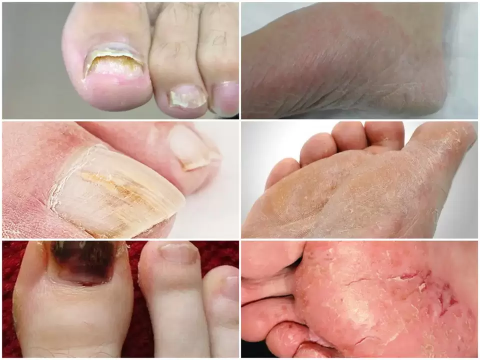 Manifestations of foot fungus due to various pathogens.