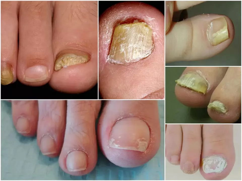 Occurrence of different forms of onychomycosis.
