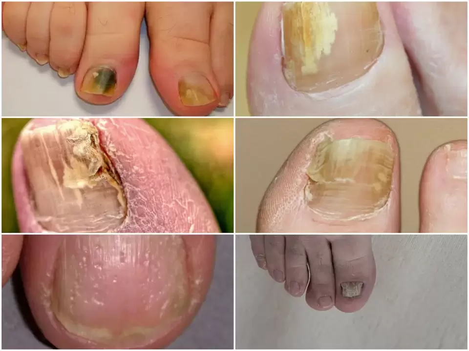 Symptoms of onychomycosis changes in the color and structure of the nails.