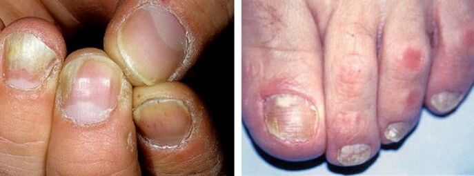 manifestations of a fungal nail infection