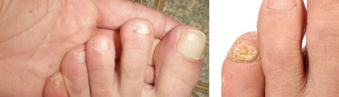 photo of manifestations of toenail fungus