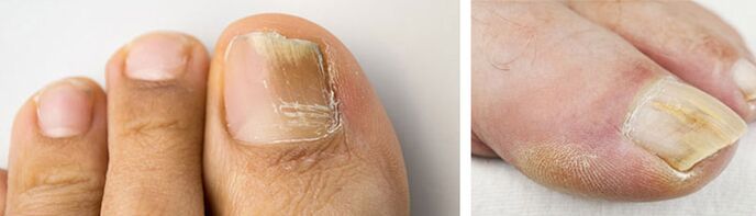 photo of a fungal infection on the nail of the big toe