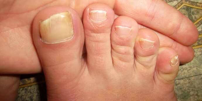 damage to toenails with fungus