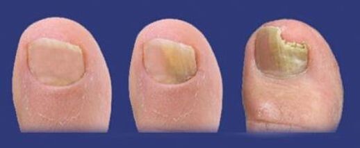 stages of development of toenail fungus. 