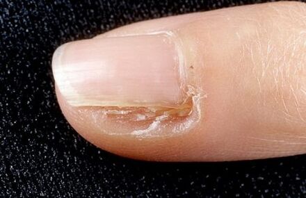 removal of part of the nail with fungus
